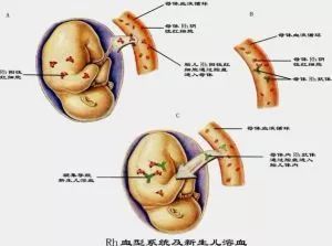 什么血型出现溶血症