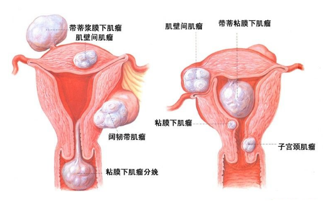 子宫肌瘤多大需要手术