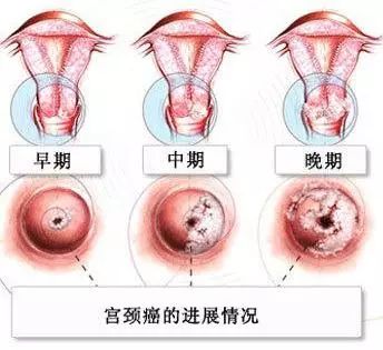 宫颈肥大需要治疗吗专家讲解