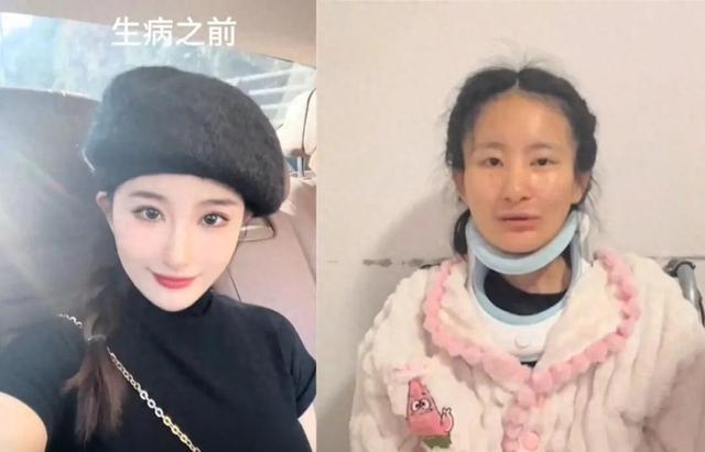 女生确诊渐冻症容貌巨变 母亲回应