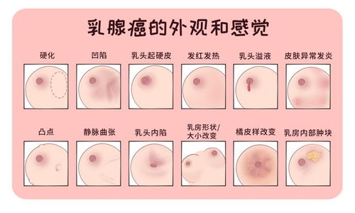 36岁女子摸到胸部疙瘩查出乳腺癌